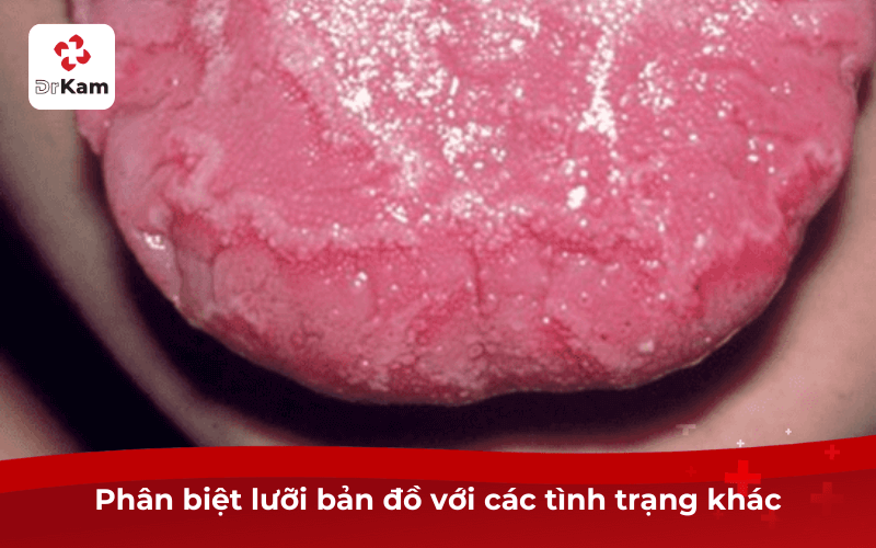 Lưỡi bản đồ là gì? Nguyên nhân, triệu chứng, phương pháp và cách phòng ngừa hiệu quả 6 Phân biệt lưỡi bản đồ với các tình trạng khác