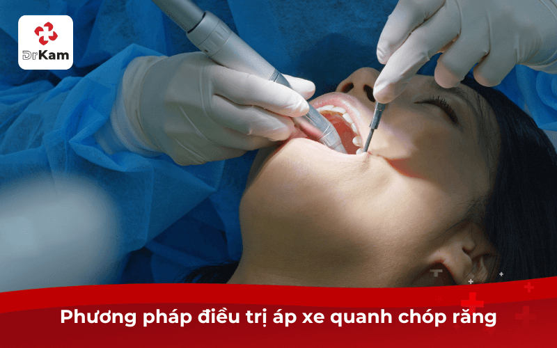 Phương pháp điều trị áp xe quanh chóp răng