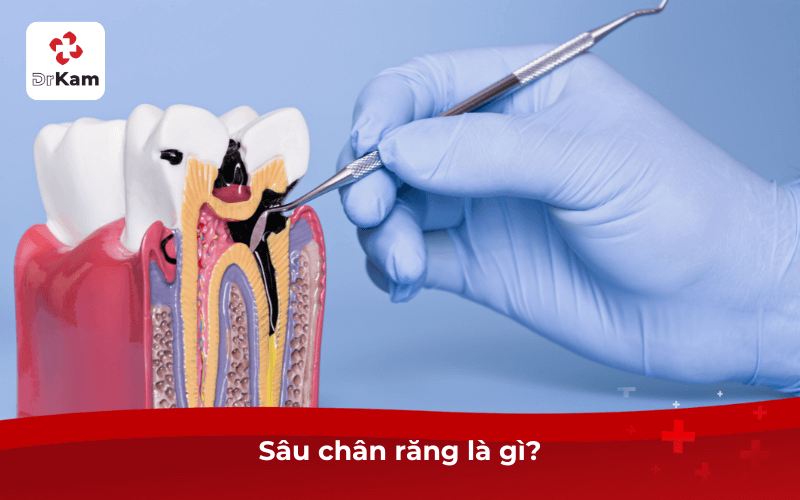 Sâu chân răng là gì?
