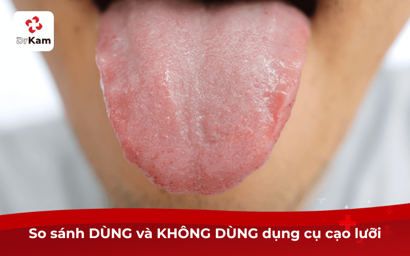So sánh DÙNG và KHÔNG DÙNG dụng cụ cạo lưỡi