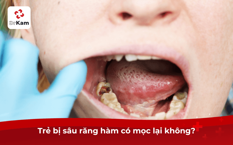 Trẻ bị sâu răng hàm có mọc lại không?