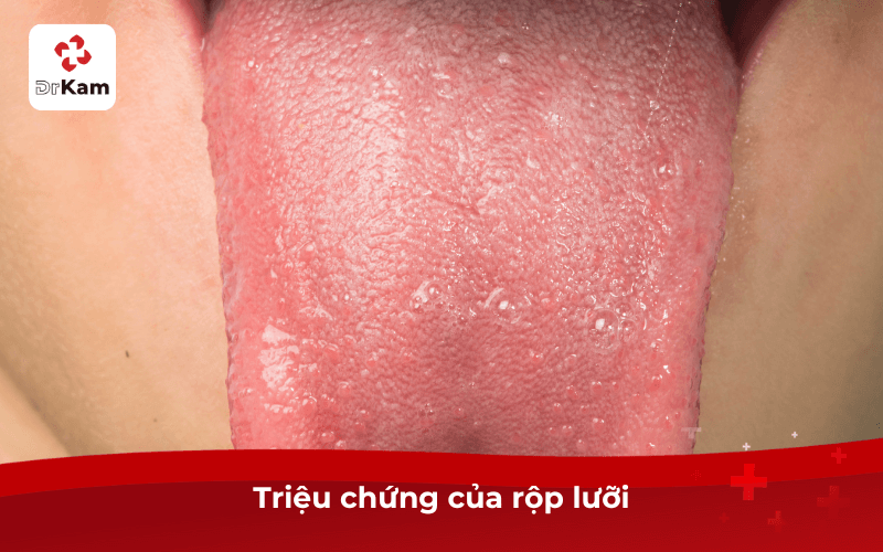 Triệu chứng của bị rộp lưỡi