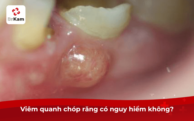 Viêm quanh chóp răng có nguy hiểm không?