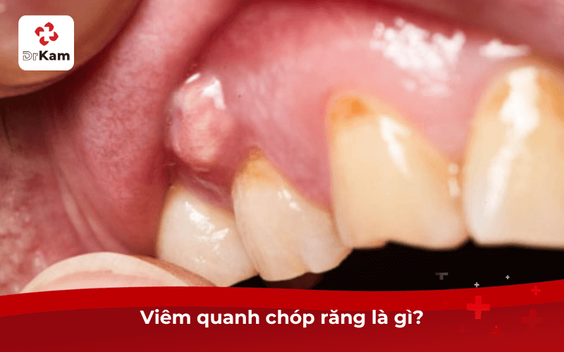 Viêm quanh chóp răng là gì?