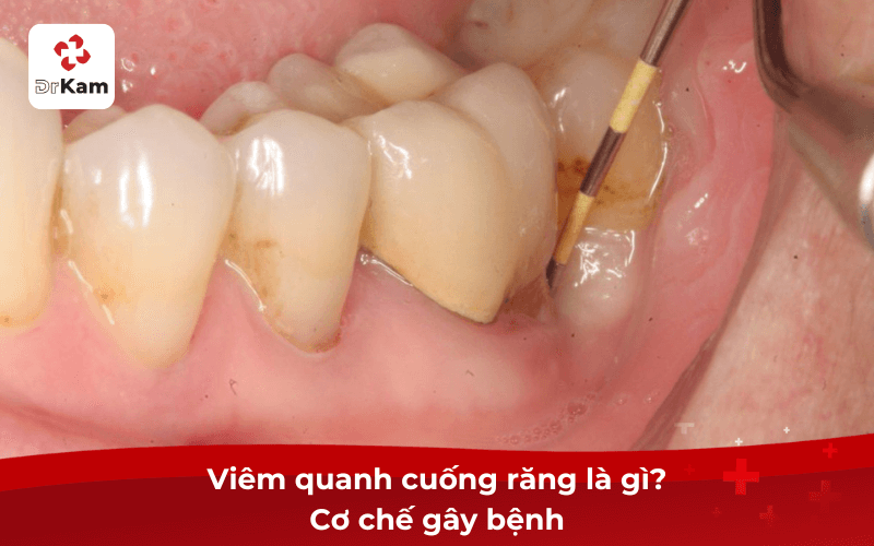 Viêm quanh cuống răng là gì? Cơ chế gây bệnh