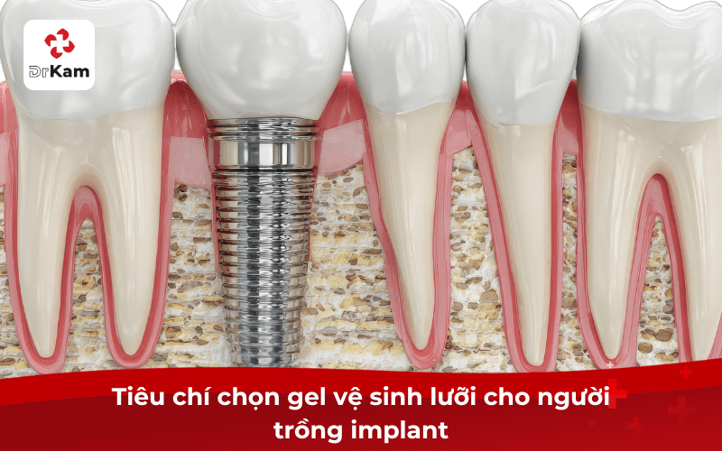 TOP 5 Gel vệ sinh lưỡi cho người trồng implant - Cách dùng an toàn đúng cách hiệu quả 5 Tiêu chí chọn gel vệ sinh lưỡi cho người trồng implant