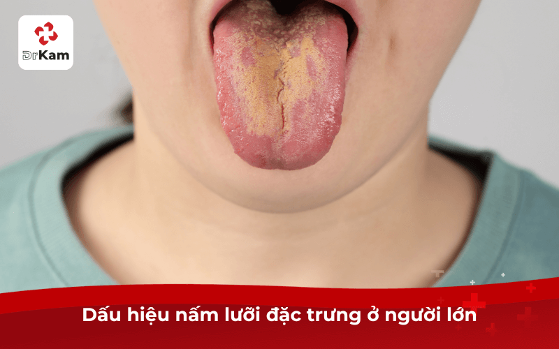 5 Dấu hiệu nấm lưỡi điển hình từ nhẹ tới nặng, từ trẻ em tới người lớn cần biết 5 Dấu hiệu nấm lưỡi đặc trưng ở người lớn