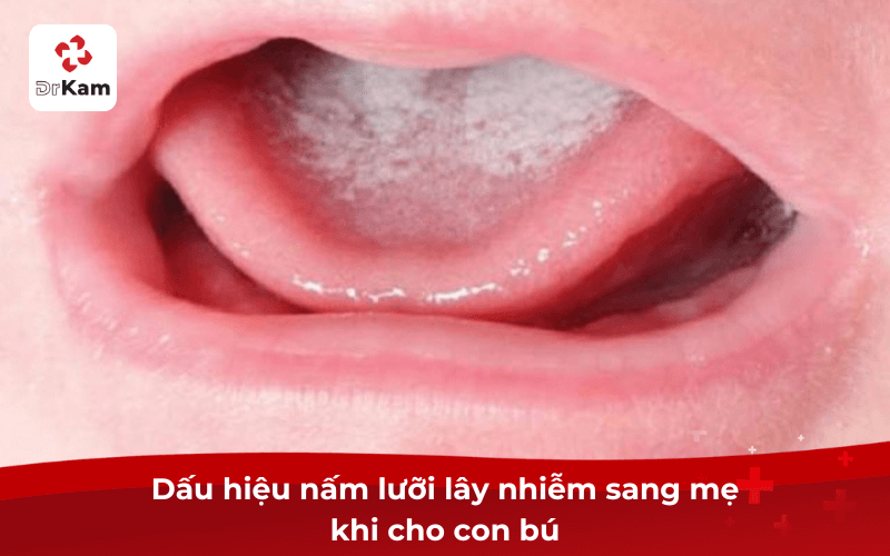 5 Dấu hiệu nấm lưỡi điển hình từ nhẹ tới nặng, từ trẻ em tới người lớn cần biết 6 Dấu hiệu nấm lưỡi lây nhiễm sang mẹ khi cho con bú