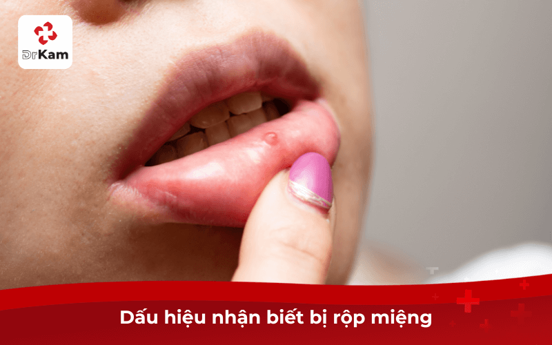 Tôi bị rộp miệng làm sao cho nhanh khỏi? Dấu hiệu, nguyên nhân và cách điều trị dứt điểm 4 Dấu hiệu nhận biết bị rộp miệng