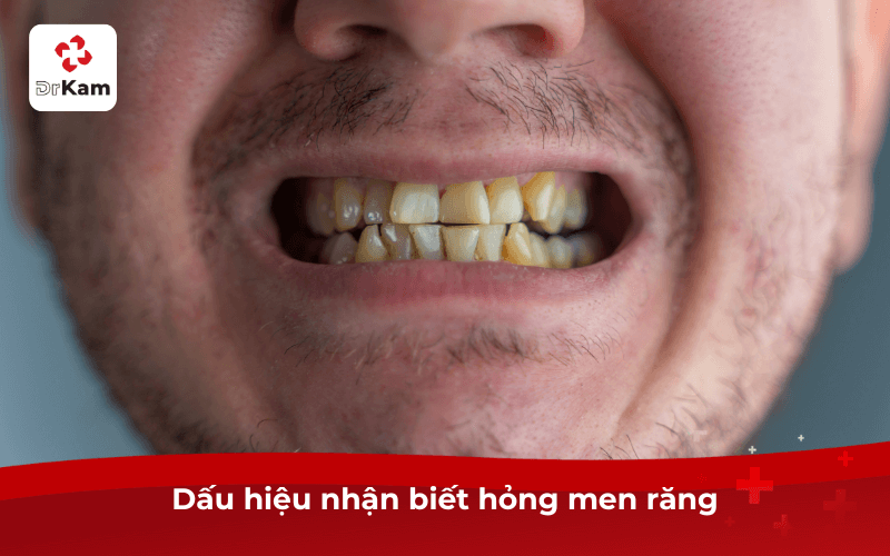 Hậu quả hỏng men răng? Dấu hiệu, nguyên nhân và cách khắc phục an toàn hiệu quả 4 Dấu hiệu nhận biết hỏng men răng