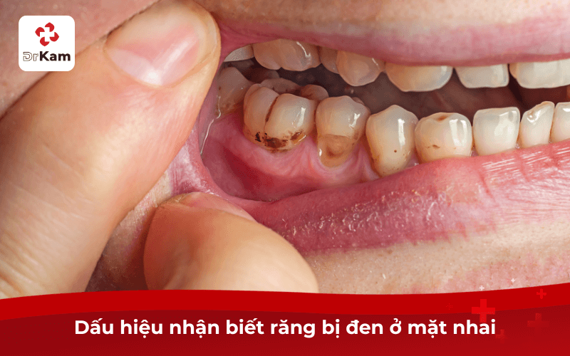 Dấu hiệu nhận biết răng bị đen ở mặt nhai