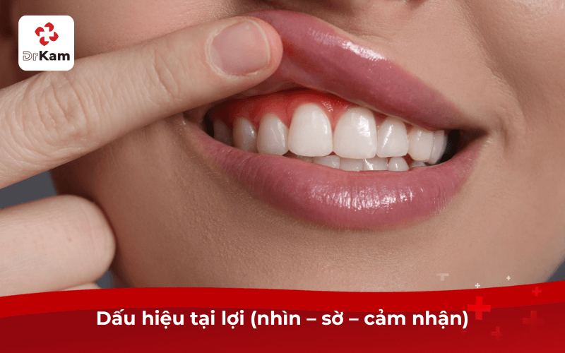 5 Dấu hiệu viêm lợi phổ biến cần điều trị ngay tránh biến chứng nặng 5 Dấu hiệu tại lợi (nhìn – sờ – cảm nhận)