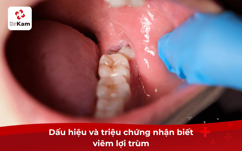 Viêm lợi trùm nguy hiểm? Nguyên nhân, dấu hiệu và cách điều trị triệt để 4 Dấu hiệu và triệu chứng nhận biết viêm lợi trùm