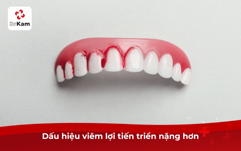 5 Dấu hiệu viêm lợi phổ biến cần điều trị ngay tránh biến chứng nặng 6 Dấu hiệu viêm lợi tiến triển nặng hơn