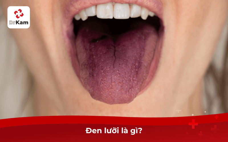 Con tôi bị đen lưỡi có sao không? Nguyên nhân, triệu chứng và cách xử lý an toàn hiệu quả 4 Đen lưỡi là gì?