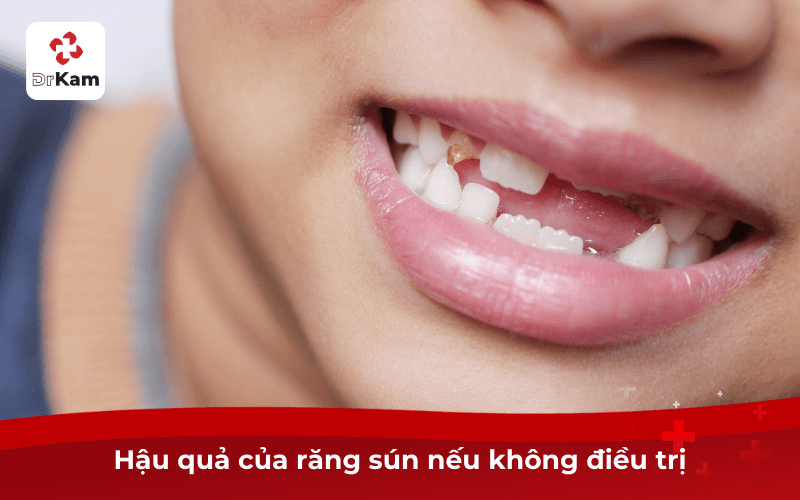 Răng sún nguy hiểm cho trẻ? Dấu hiệu, triệu chứng, giai đoạn sún và cách điều trị hiệu quả 6 Hậu quả của răng sún nếu không điều trị