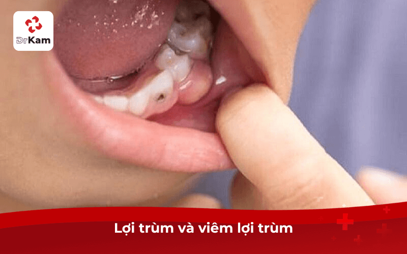 Hình ảnh thực tế lợi trùm? Nguyên nhân, phương pháp, quy trình và cách phòng ngừa cần biết 4 Lợi trùm và viêm lợi trùm
