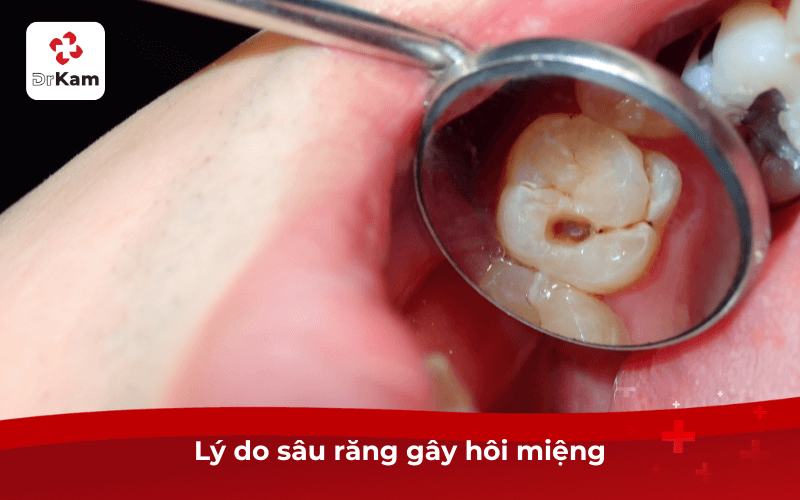 Lý do sâu răng có gây hôi miệng