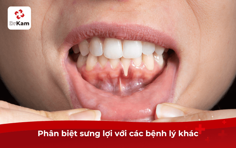 Tôi bị sưng lợi đau? Nguyên nhân, cách điều trị dứt điểm áp dụng ngay 6 Phân biệt sưng lợi với các bệnh lý khác