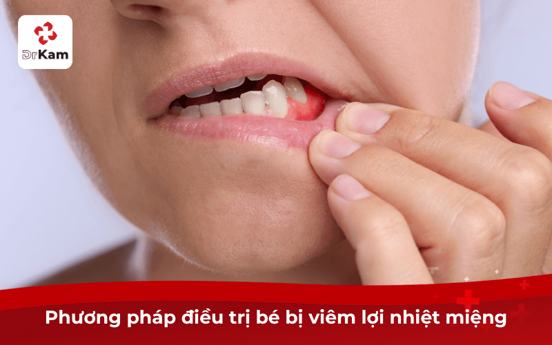 Bé bị viêm lợi nhiệt miệng có sao không? Nguyên nhân, dấu hiệu, biện pháp phòng ngừa 5 Phương pháp điều trị bé bị viêm lợi nhiệt miệng
