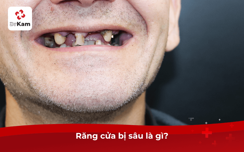 Răng cửa bị sâu - Nguyên nhân, dấu hiệu và cách điều trị hiệu quả 3 Răng cửa bị sâu là gì?