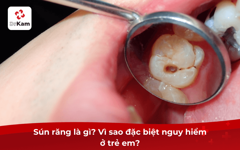 Răng sún nguy hiểm cho trẻ? Dấu hiệu, triệu chứng, giai đoạn sún và cách điều trị hiệu quả 5 Răng sún là gì? Vì sao đặc biệt nguy hiểm ở trẻ em?