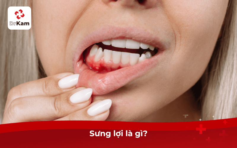 Tôi bị sưng lợi đau? Nguyên nhân, cách điều trị dứt điểm áp dụng ngay 5 Sưng lợi là gì?