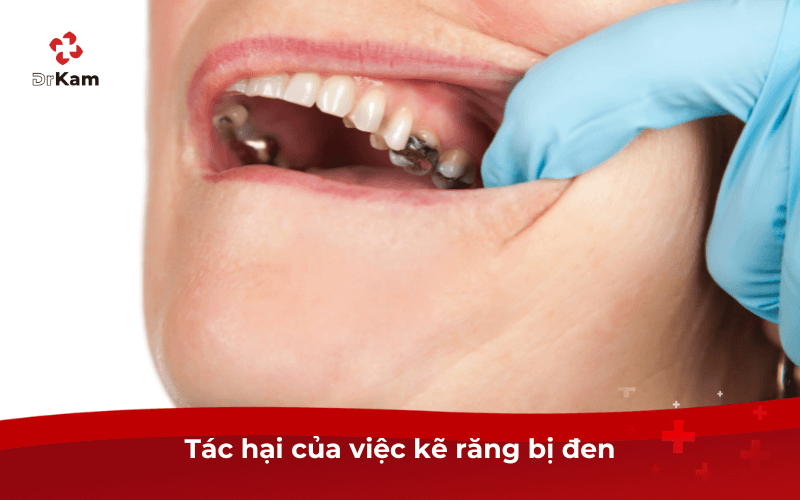 Kẽ răng bị đen tôi phải làm sao? Nguyên nhân, tác hại và cách xử lý hiệu quả 4 Tác hại của việc kẽ răng bị đen