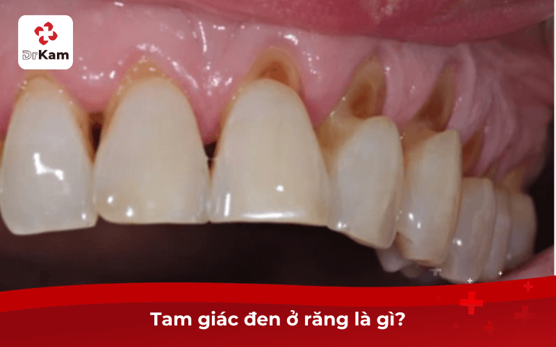Con tôi bị tam giác đen ở răng có sao không? Nguyên nhân và phương pháp xử lý hiệu quả 4 Tam giác đen ở răng là gì?
