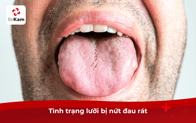 Tình trạng lưỡi bị nứt đau rát