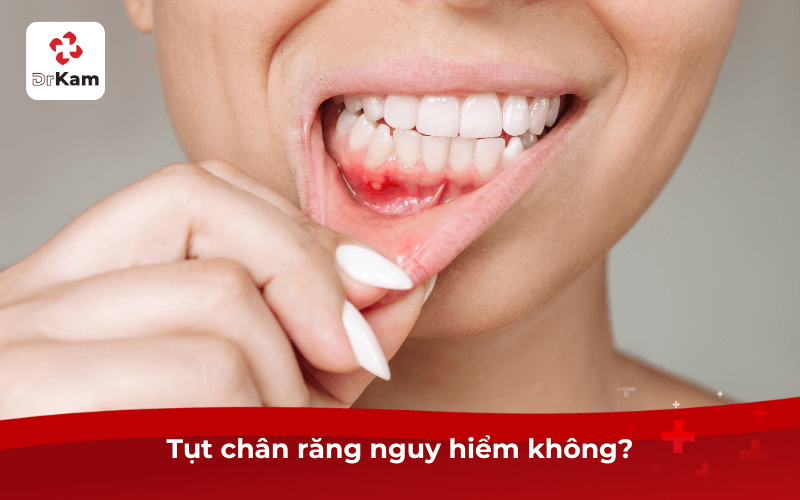 Tôi bị tụt chân răng có sao không? Dấu hiệu, nguyên nhân và phương pháp điều trị hiệu quả 4 Tụt chân răng nguy hiểm không?