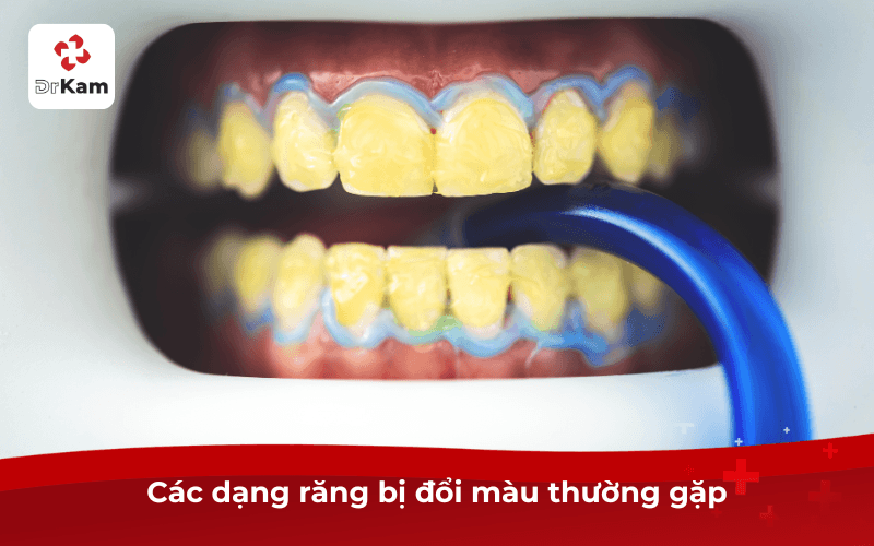 Các dạng răng bị đổi màu thường gặp