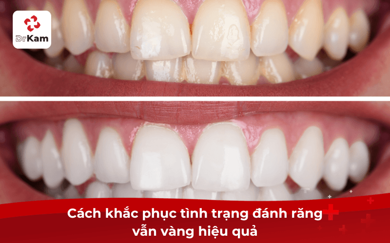 Tôi đánh răng vẫn vàng phải làm sao - Nguyên nhân và cách khắc phục hiệu quả 4 Cách khắc phục tình trạng đánh răng vẫn vàng hiệu quả