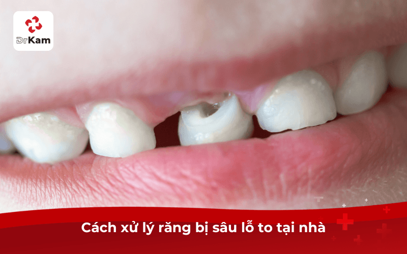 Tôi răng bị sâu lỗ to phải làm sao? 12 cách trị sâu lỗ to dứt điểm 4 Cách xử lý răng bị sâu lỗ to tại nhà