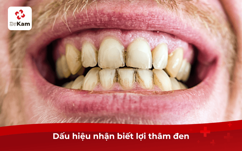 Lợi thâm đen tôi phải làm sao - Nguyên nhân, tác hại và cách cải thiện hiệu quả 4 Dấu hiệu nhận biết lợi thâm đen