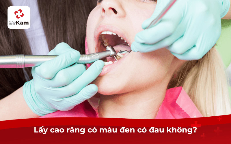 Lấy cao răng màu đen có đau không?