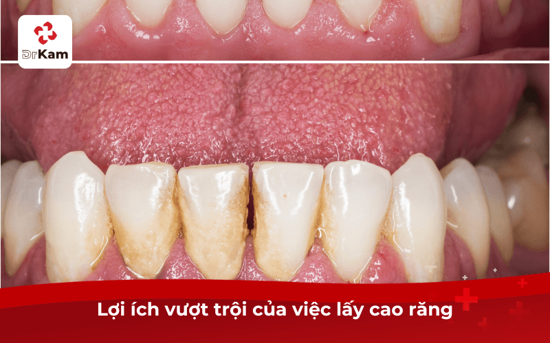 Lấy cao răng có tốt không - 4 lợi ích vượt trội và cách duy trì răng sạch bóng hiệu quả 4 Lấy cao răng có tốt không?