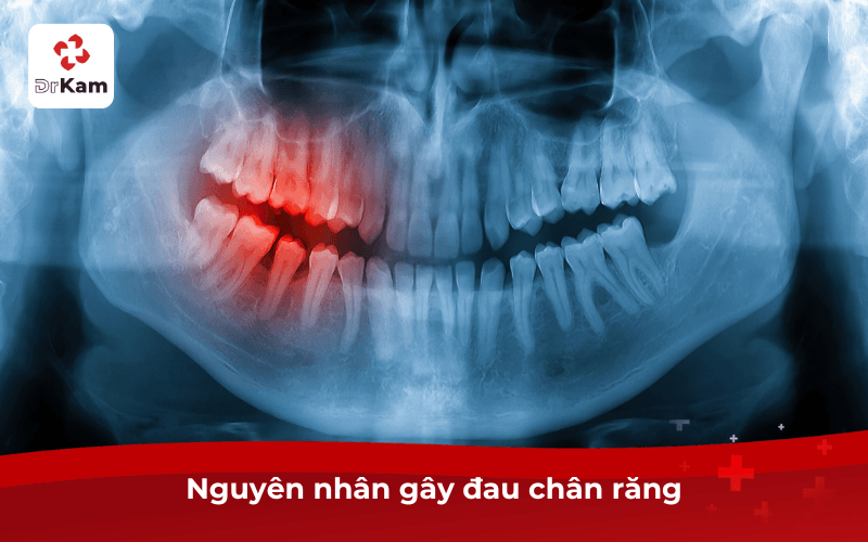 Tôi bị đau chân răng phải làm sao - Nguyên nhân, tác hại và cách điều trị hiệu quả 4 Nguyên nhân gây đau chân răng