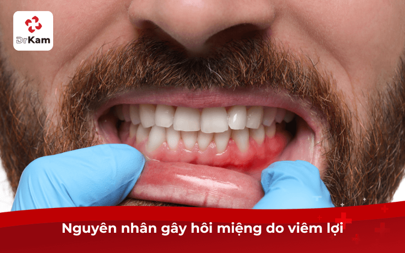 Tôi bị hôi miệng do viêm lợi làm sao hết? Nguyên nhân, cách khắc phục hiệu quả 4 Nguyên nhân gây hôi miệng do viêm lợi