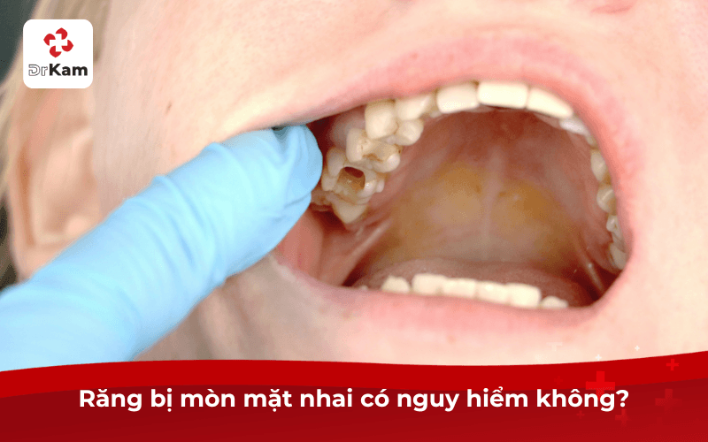 Răng bị mòn mặt nhai có nguy hiểm không?