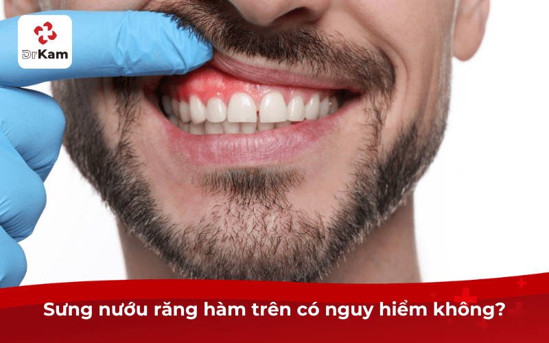 Tôi bị sưng nướu răng hàm trên sao không? Nguyên nhân và cách điều trị hiệu quả 4 Sưng nướu răng hàm trên có nguy hiểm không?