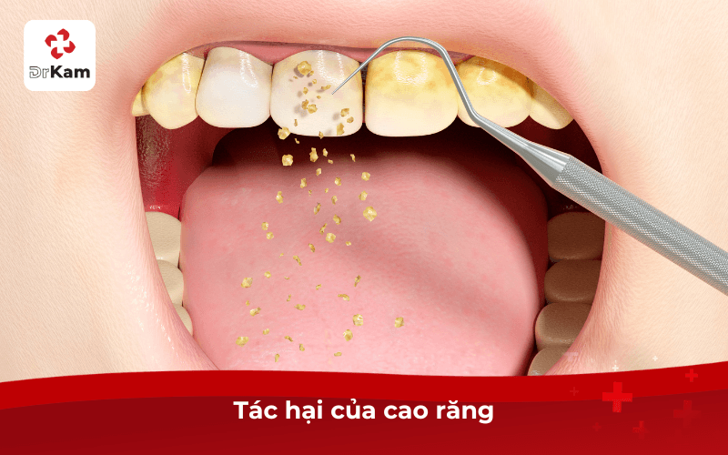 Tác hại của cao răng
