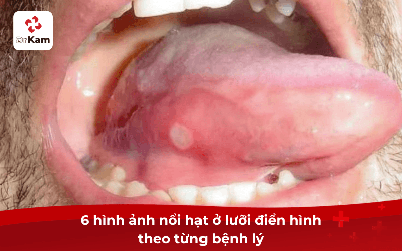 Thực tế 6 hình ảnh nổi hạt ở lưỡi điển hình theo bệnh lý cần chú ý 5 6 hình ảnh nổi hạt ở lưỡi điển hình theo từng bệnh lý