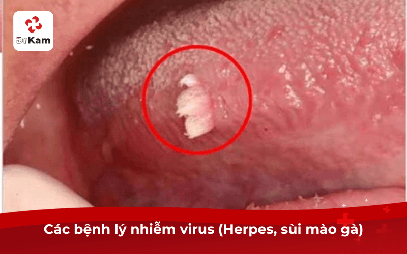 Thực tế 6 hình ảnh nổi hạt ở lưỡi điển hình theo bệnh lý cần chú ý 6 Các bệnh lý nhiễm virus (Herpes, sùi mào gà)
