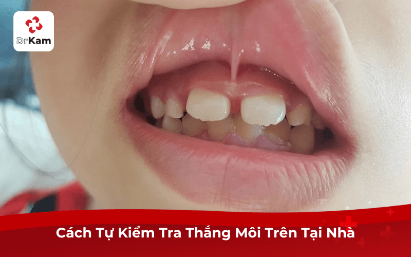 Review hình ảnh thắng môi trên bình thường phụ huynh nên chú ý 5 Hình ảnh thắng môi trên bình thường