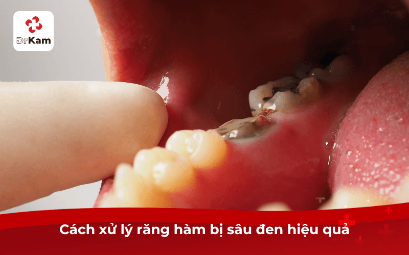 Răng hàm bị sâu đen phải làm sao