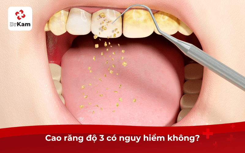 Con tôi cao răng độ 3 có sao không? Tác hại, cách xử lý và phòng ngừa cao răng hiệu quả 4 Cao răng độ 3 có nguy hiểm không?