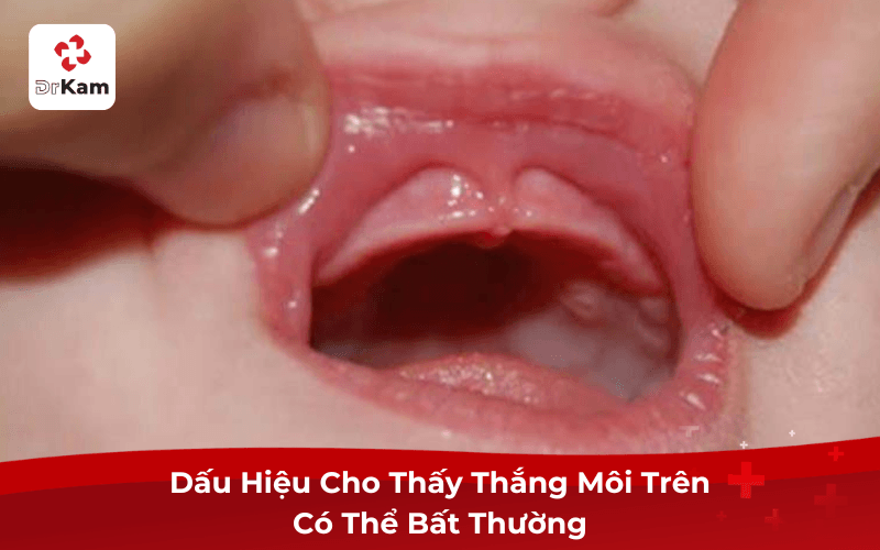 Review hình ảnh thắng môi trên bình thường phụ huynh nên chú ý 6 Dấu Hiệu Cho Thấy Thắng Môi Trên Có Thể Bất Thường