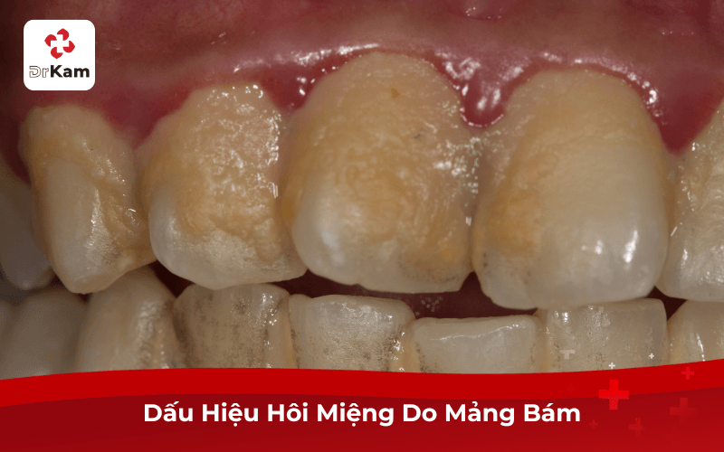 Dấu Hiệu Hôi Miệng Do Mảng Bám