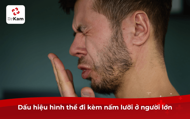 Dấu hiệu hình thể đi kèm nấm lưỡi ở người lớn